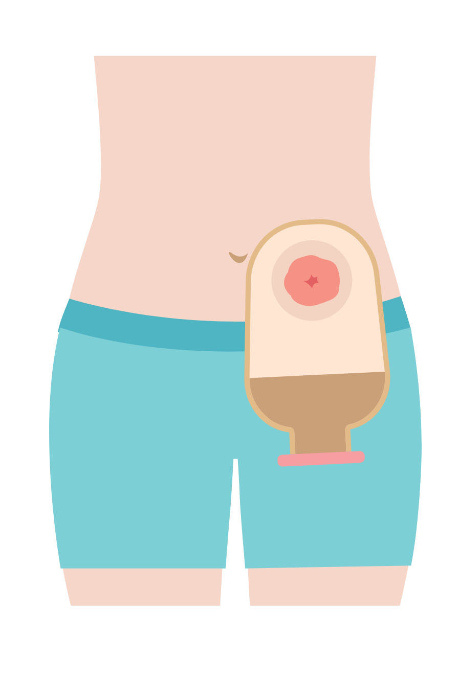 ストーマのイラスト